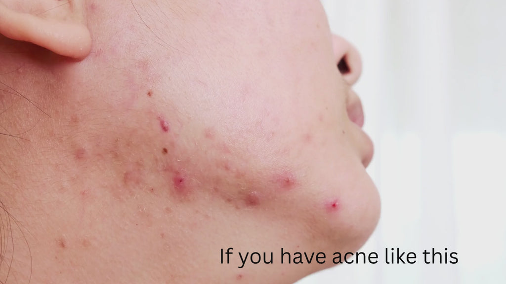 PanOxyl Acne Clear Routine Set – 10% Benzoyl Peroxide Wash + Oil Control SPF Moisturiser + Repair Cream
